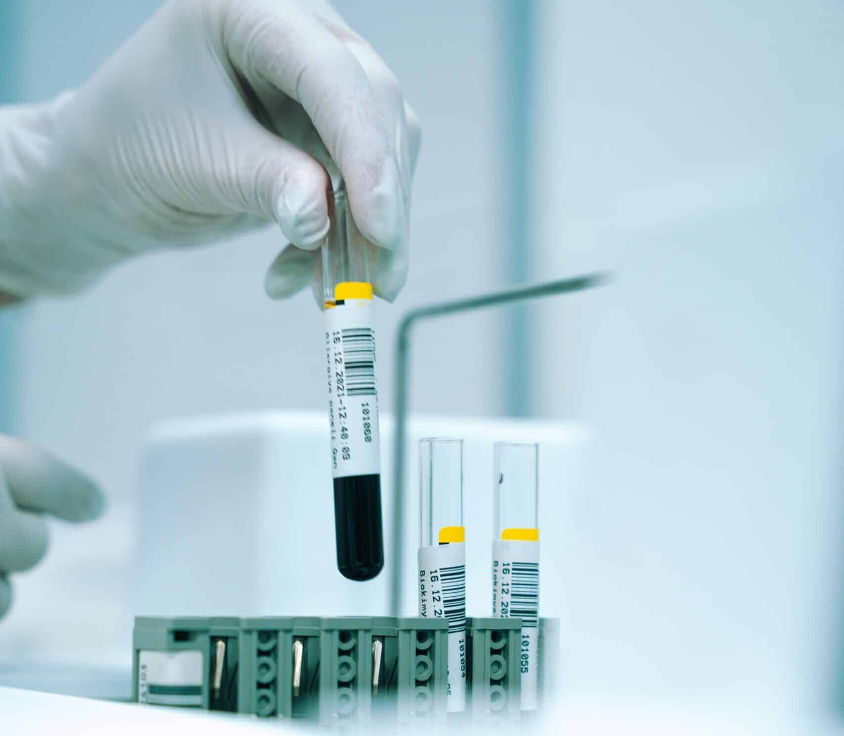 Laborprobe im Reagenzglas bei medizinischer Analyse